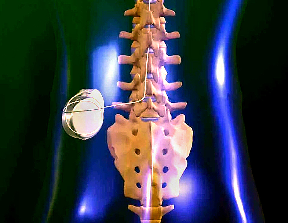 Illustration: spinal cord stimulator