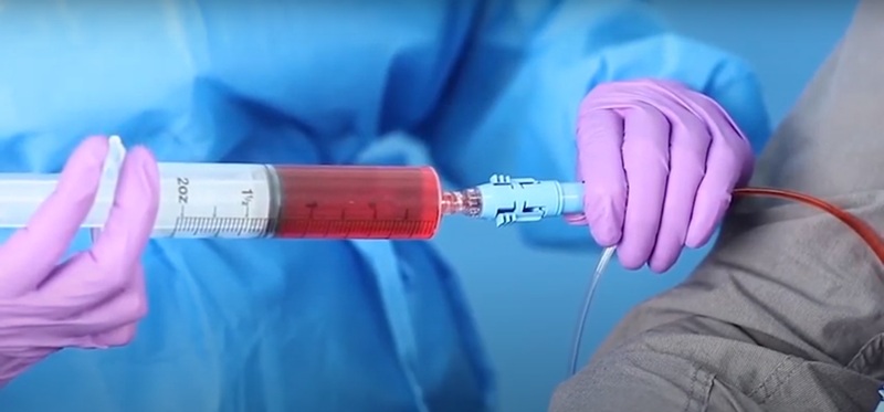 A healthcare worker dressed in blue scrubs with pink gloves uses the ClickLock device on a patient.